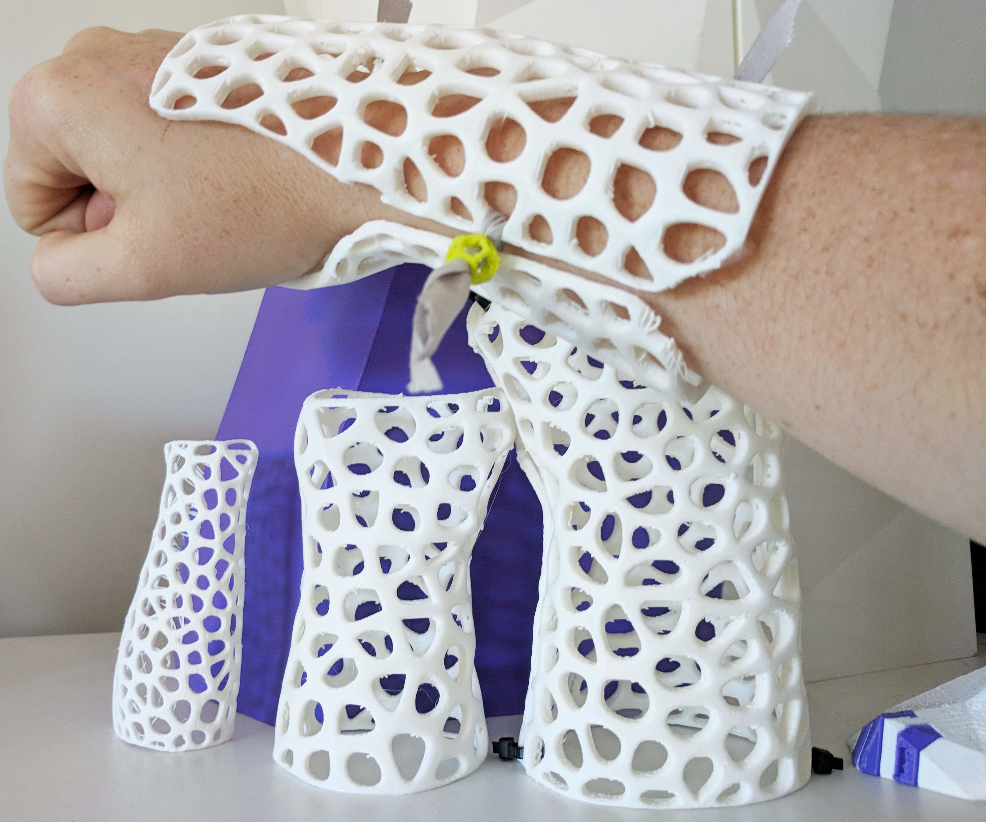 How to Design Custom, 3D Printable Braces for Arm Injury