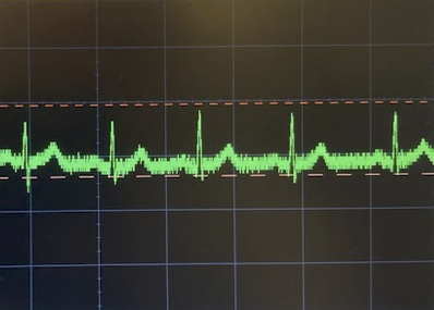 Designing an ECG: Extra Cool Gizmo