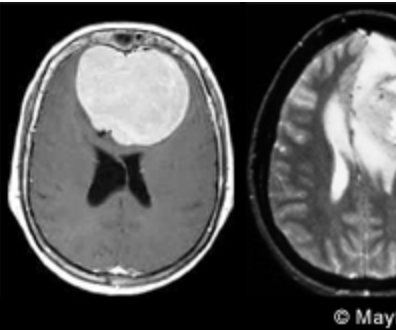 Brain Cancer Detector