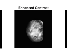 Using Varying Gray Scale Intensity Thresholds to Visualize and Identify Abnormalities in Mammogram Images