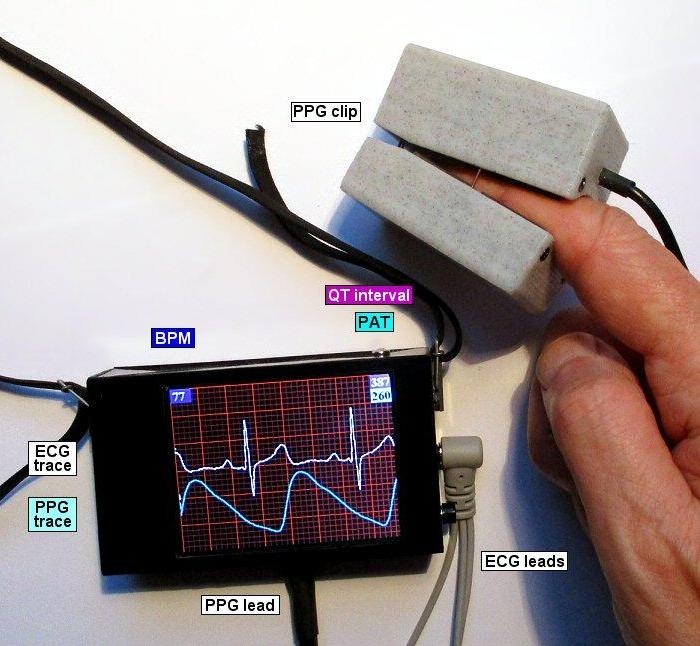 ECG With PPG Using Arduino