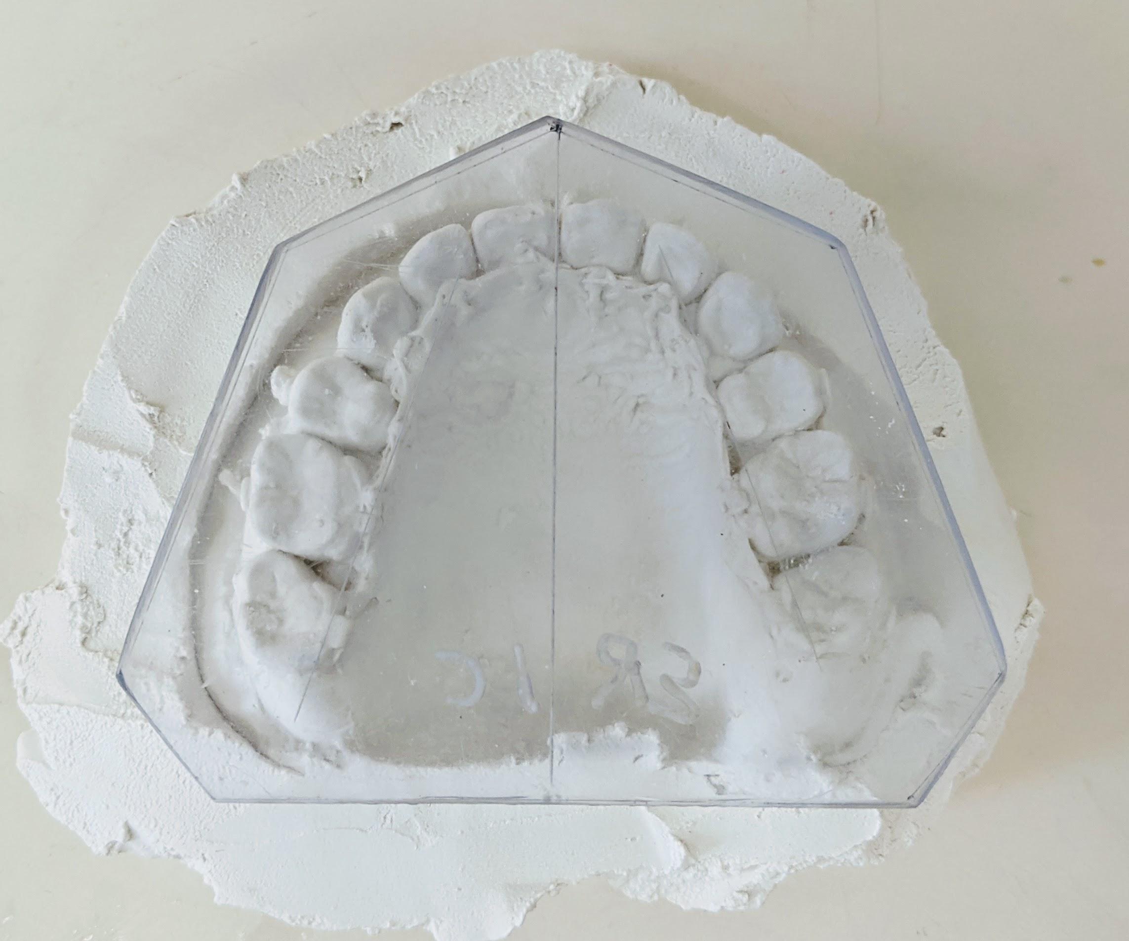 A New Method for Trimming Orthodontic Study Model