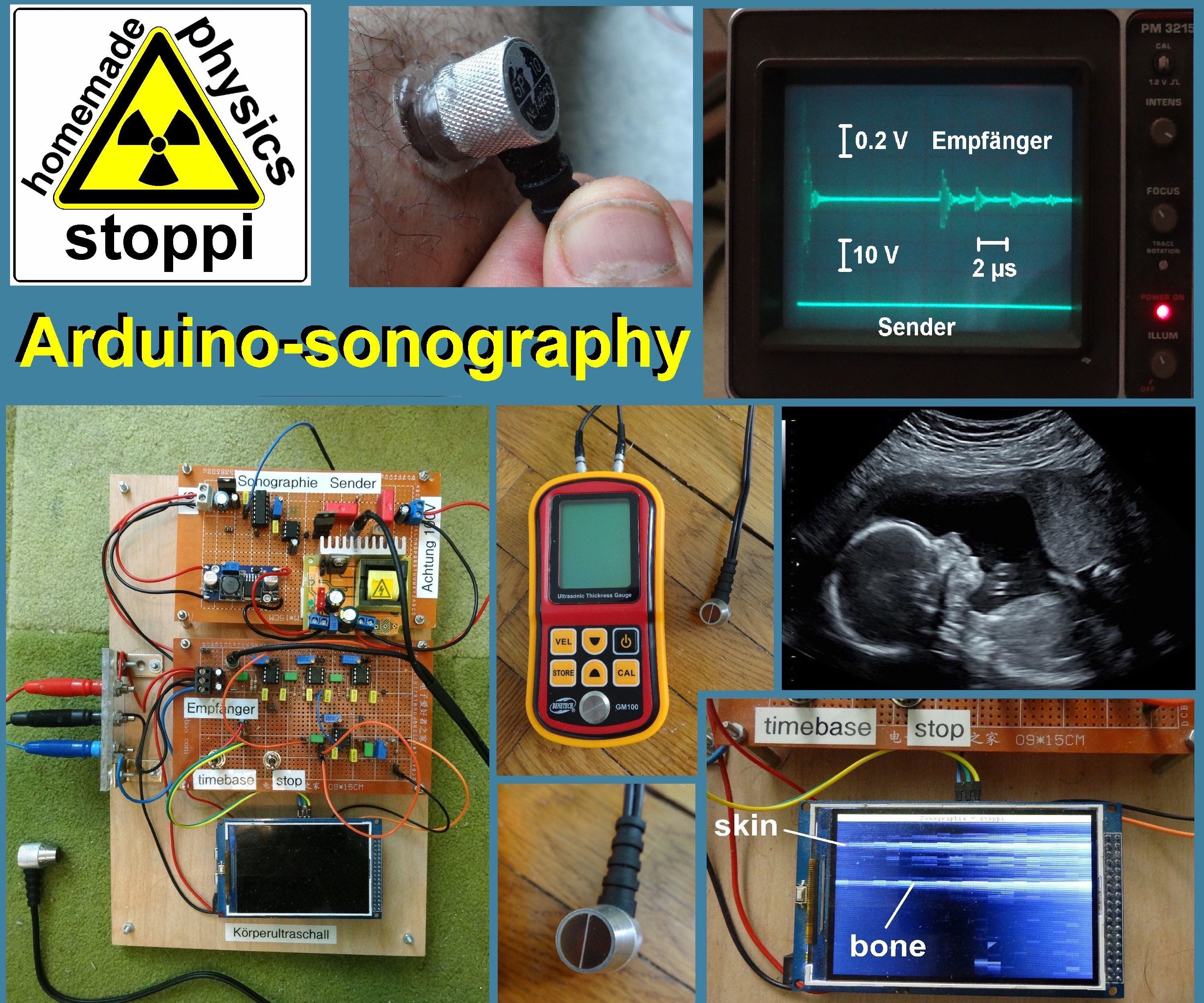 Body-ultrasound Sonography With Arduino