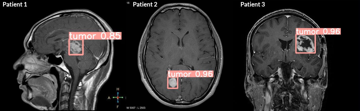 Brain Tumor Identification on Brainy Pi