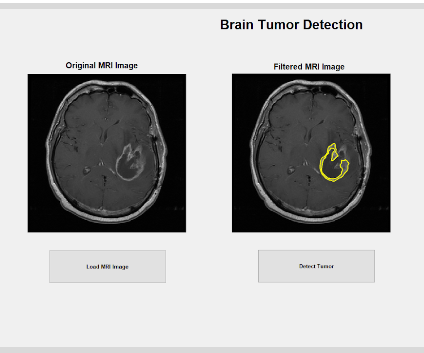 Brain Tumor MRI Detection Using Matlab