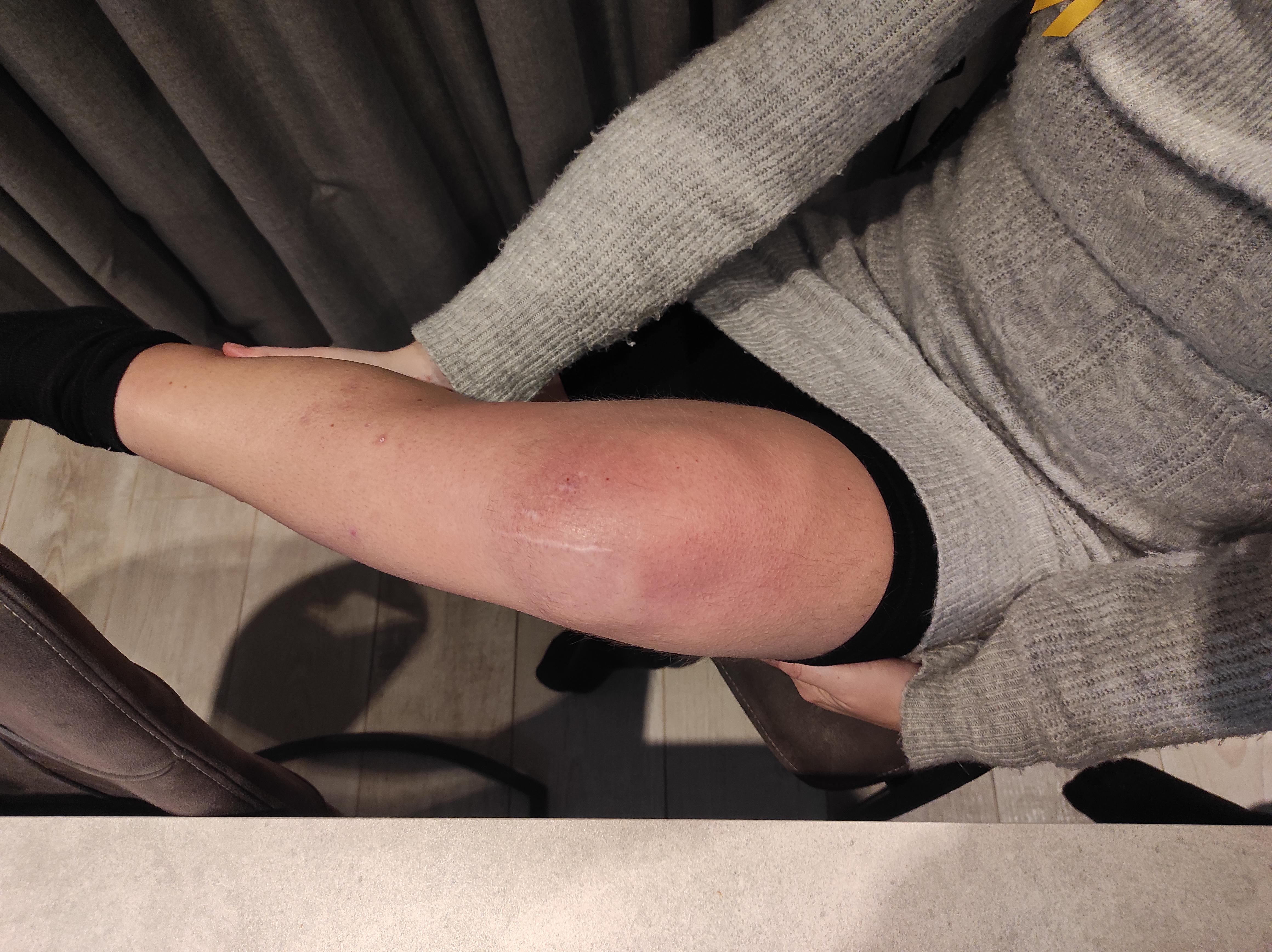 0.1 Probleemstelling knie.jpg