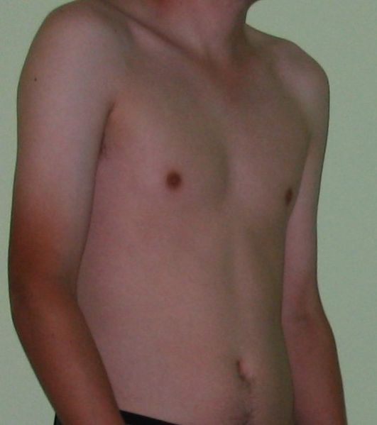 531px-Male_torso.jpg