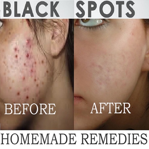 Clear Acne Marks  Dark scars  Pimple spotsss.jpg