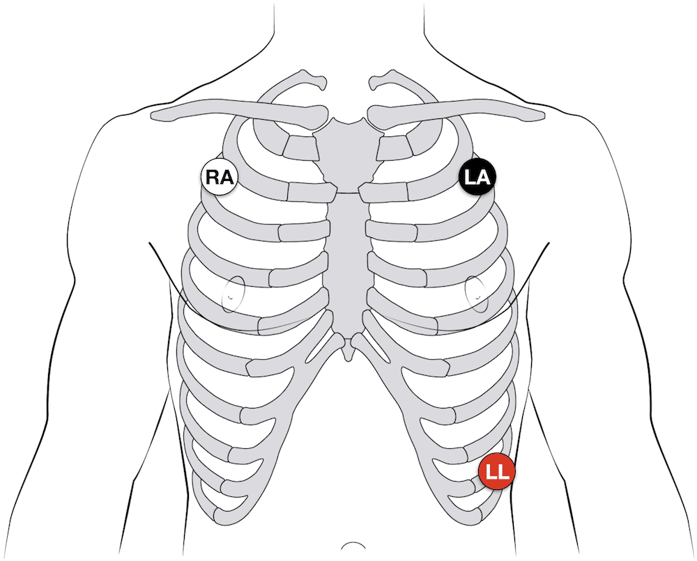 ECG-3-lead-electrode-ECG.png