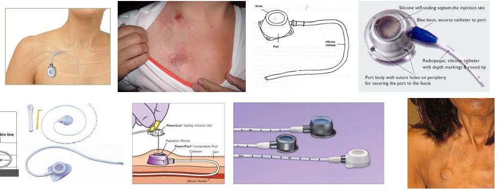 Google Image Search - Catheter Port.JPG