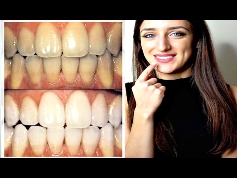 HOW TO WHITEN YOUR TEETH AT HOME NATURALLY IMMEDIATE RESULTS WITHOUT DAMAGING THEM! !