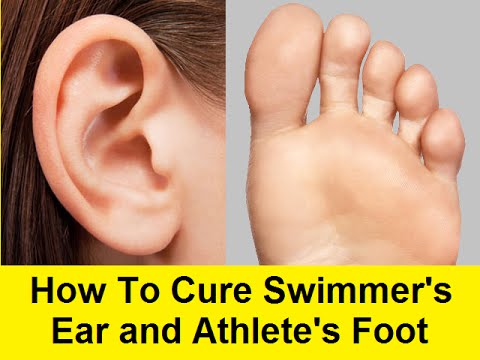 How To Cure Swimmer's Ear and Athlete's Foot