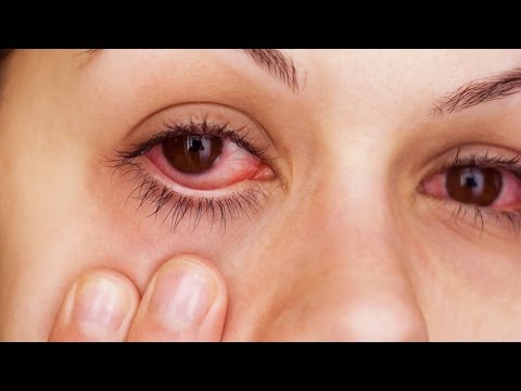 How To Instantly Relieve Itchy/Irritated Allergy Eyes!!