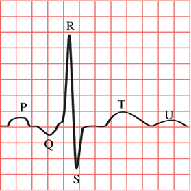 LEAD 2 ECG.png