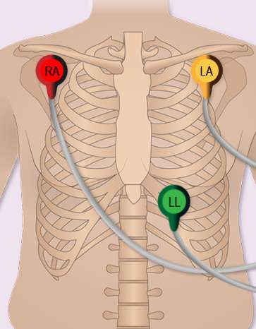 Lead Placement 3.jpg