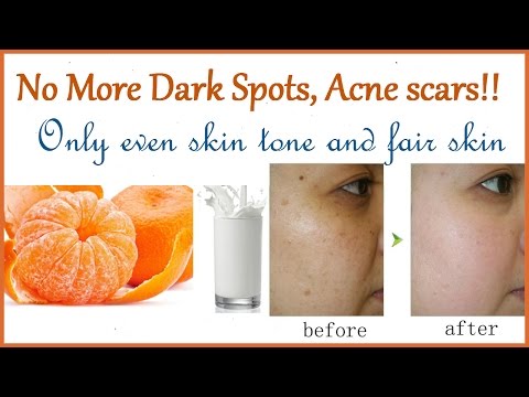 NO MORE DARK Spots, ACNE scars: This Mask Removes Them All!! Fair Skin care tips video