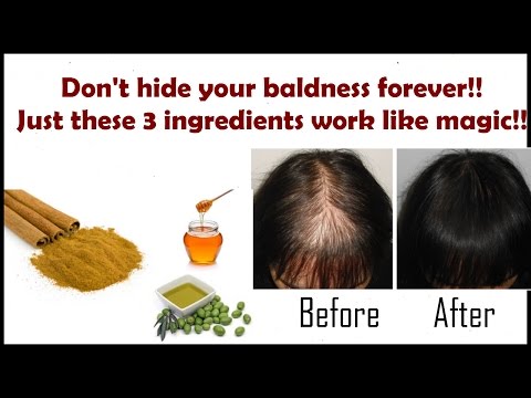 New Miracle Baldness Treatment Recipe, After Few Days Your Hair Will Begin To Grow Back