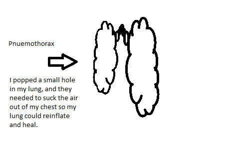 Pneumothorax.png