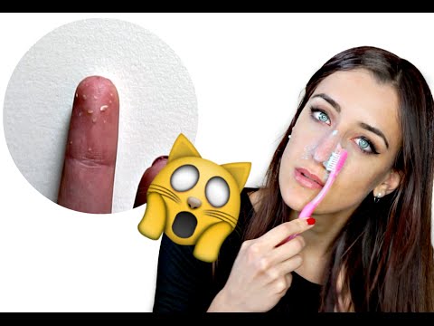 Remove ALL Blackheads PERMANENTLY! IT WORKS!