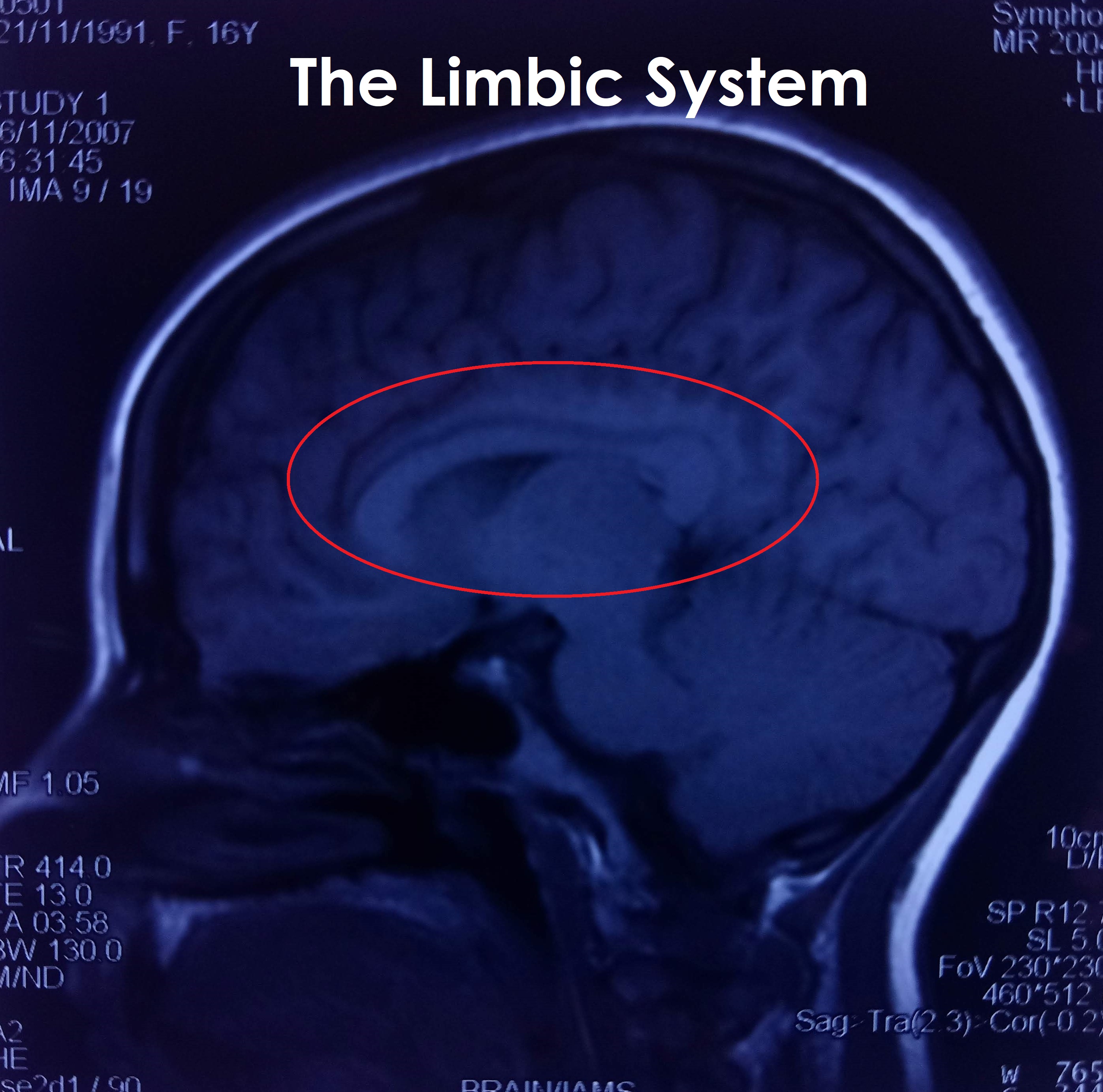 Side View with Limbic Area 1- Limbic System Labelled.jpg