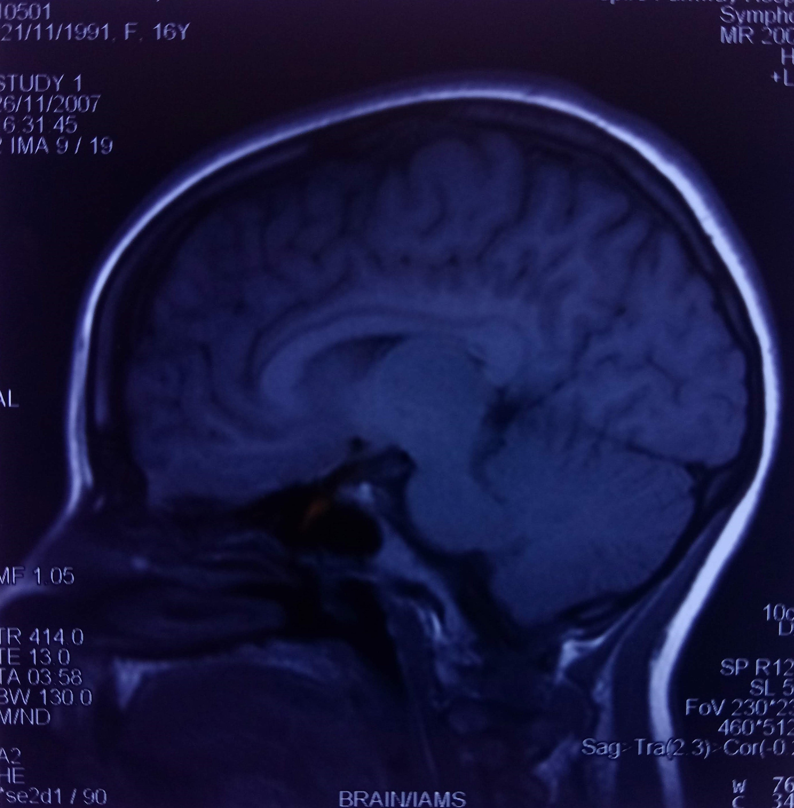 Side View with Limbic Area 2.jpg