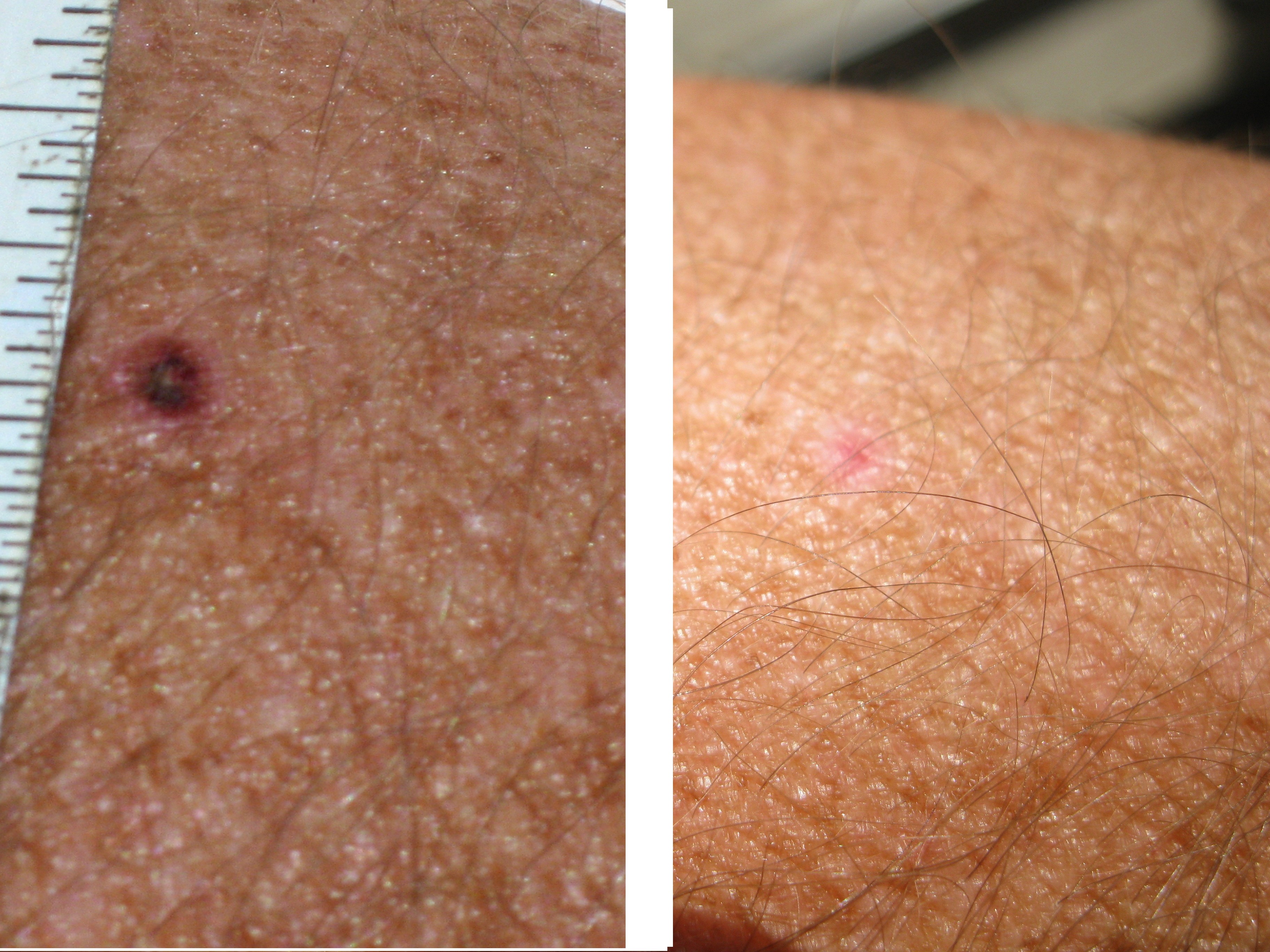 Small Wart Before and After.JPG