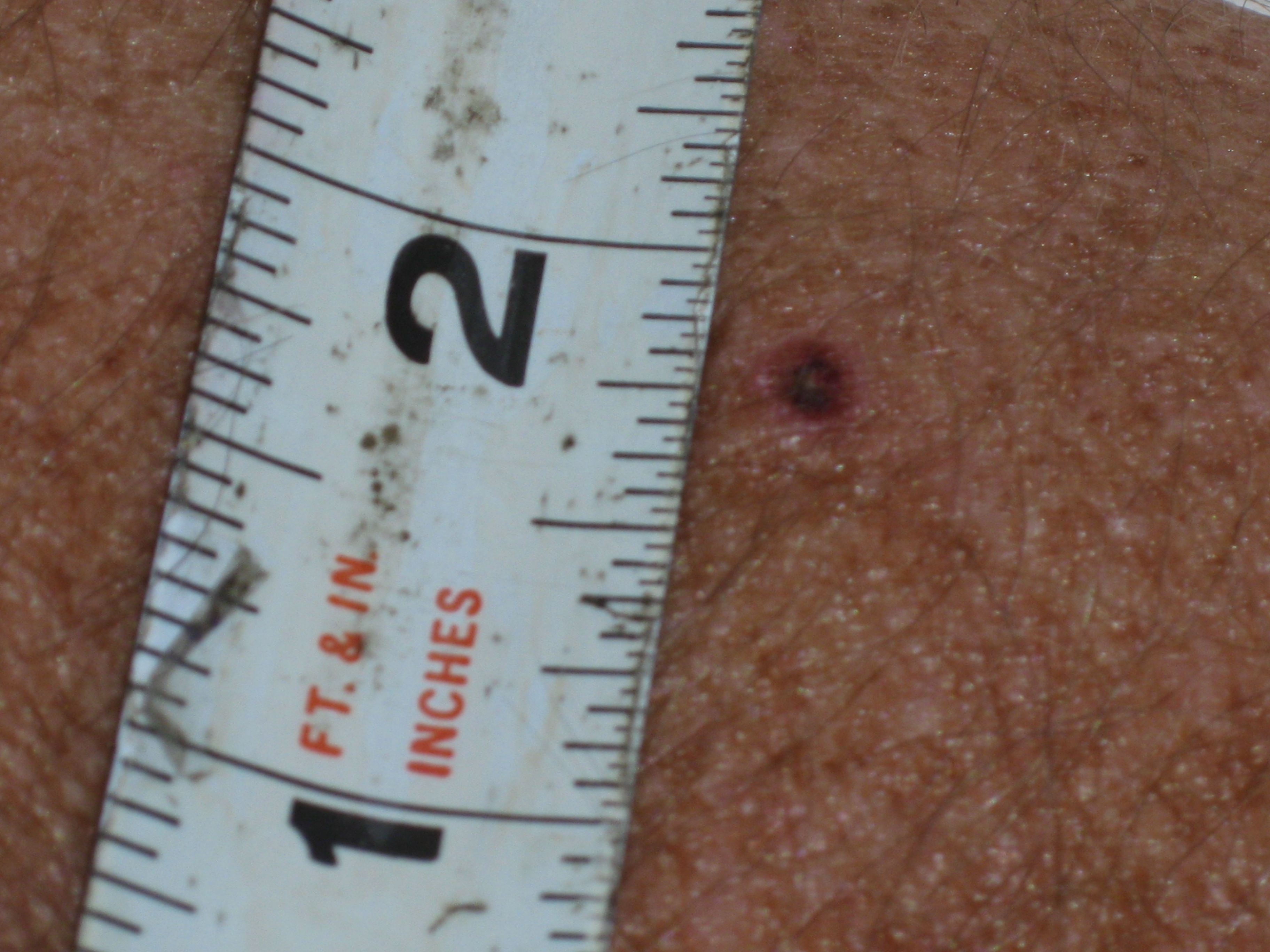 Small Wart IMG_0413.JPG