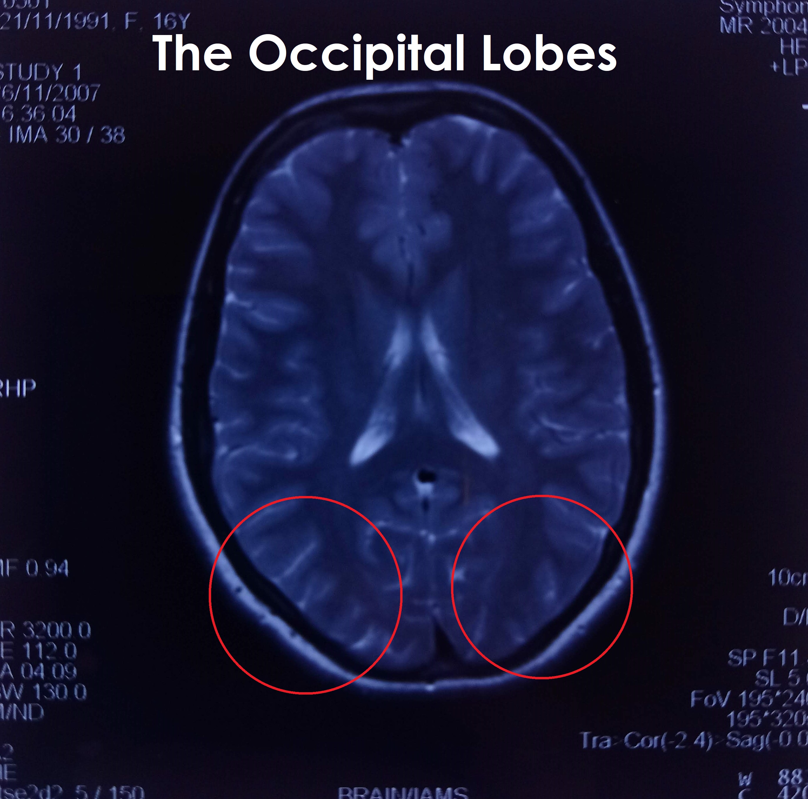 View from Top 2- Occipital Lobe Labelled.jpg