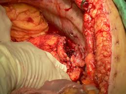 abdominal wound.jpg