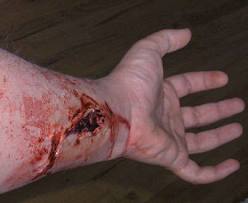 arm wound.jpg