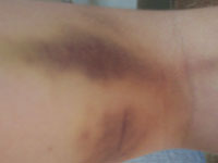 bruise.jpg