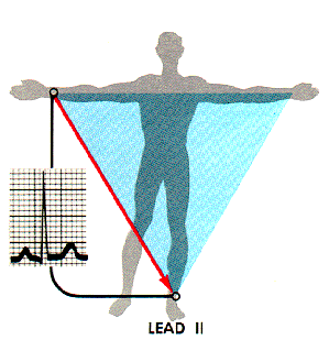 ecg image.gif