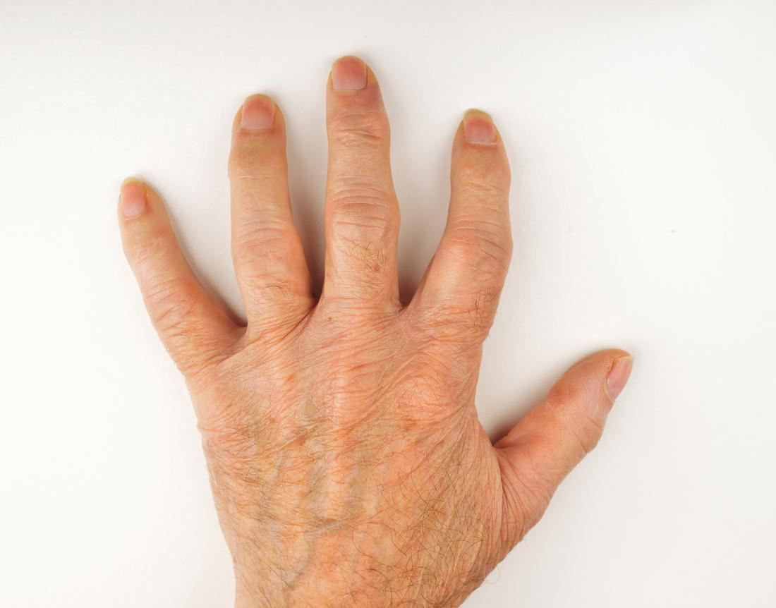 hand-spread-out-showing-arthritis-swelling.jpg