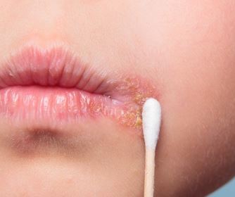 how-to-get-rid-of-cold-sores-at-home-1.jpg