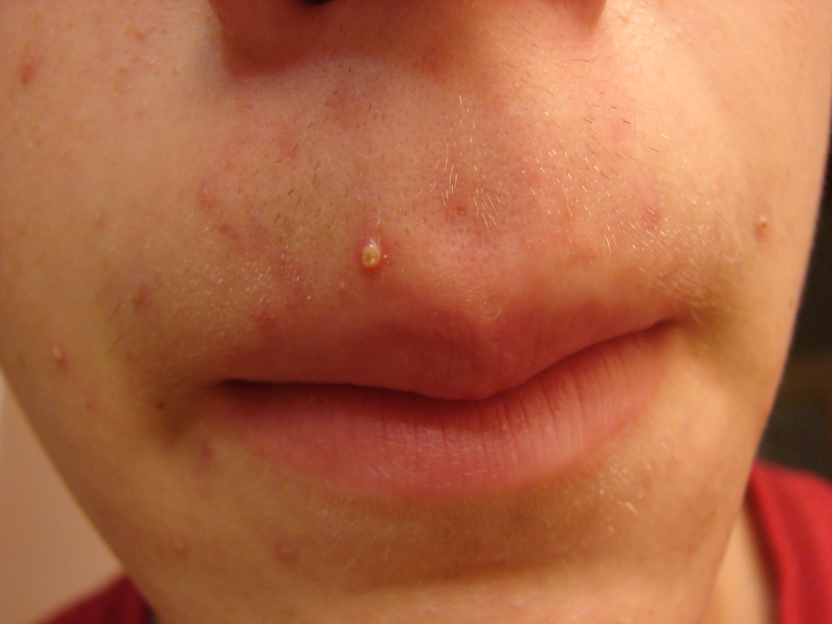 pimple4.jpg