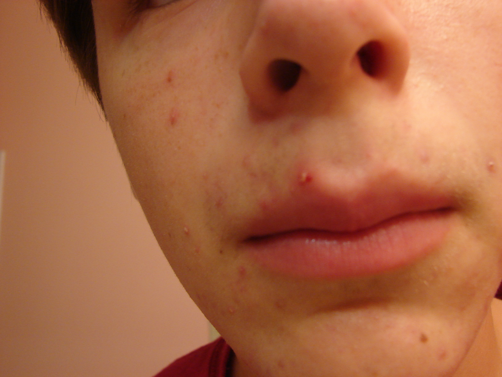 pimple7.jpg