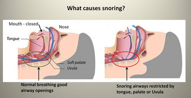 snoringcauses.jpg