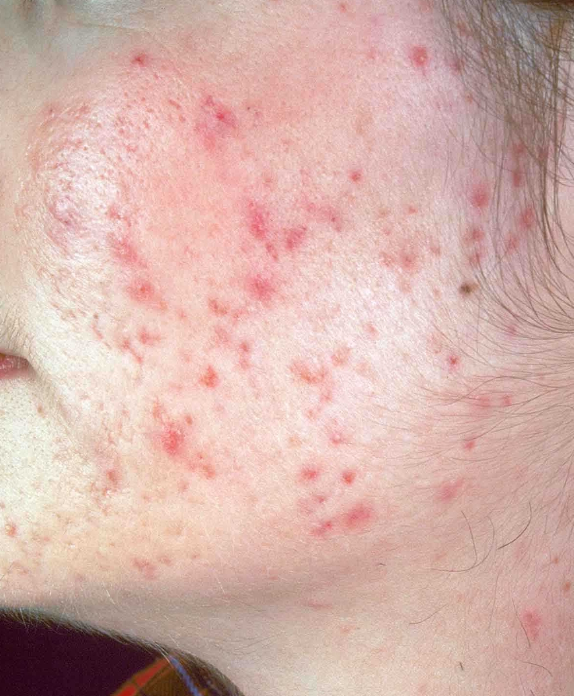 teen-acne1-crop.jpg