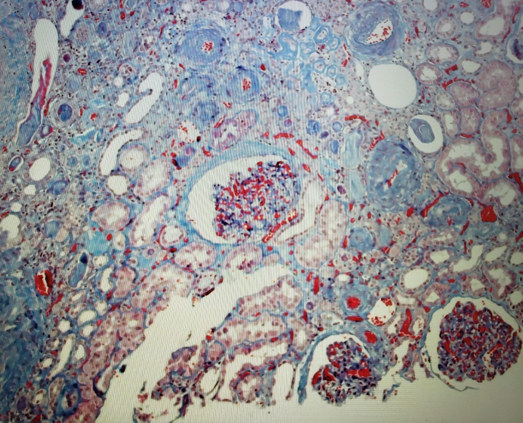 trichrome oversaturation of hematoxylin.jpeg