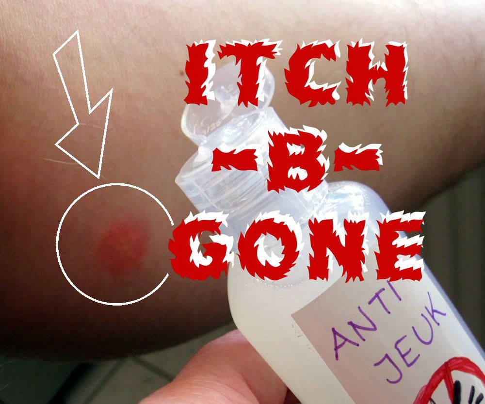 Itch-B-Gone