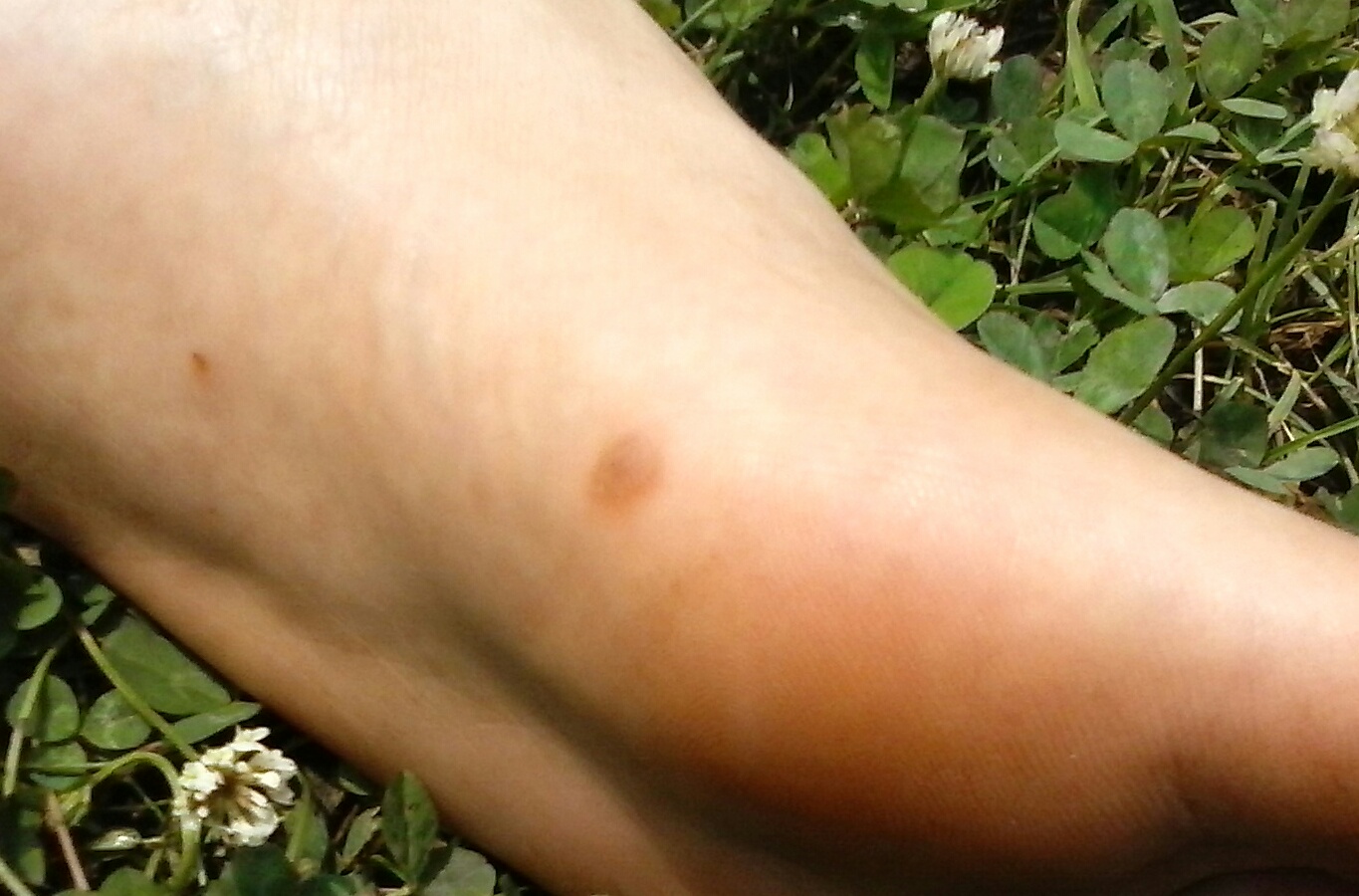 How to get rid of warts