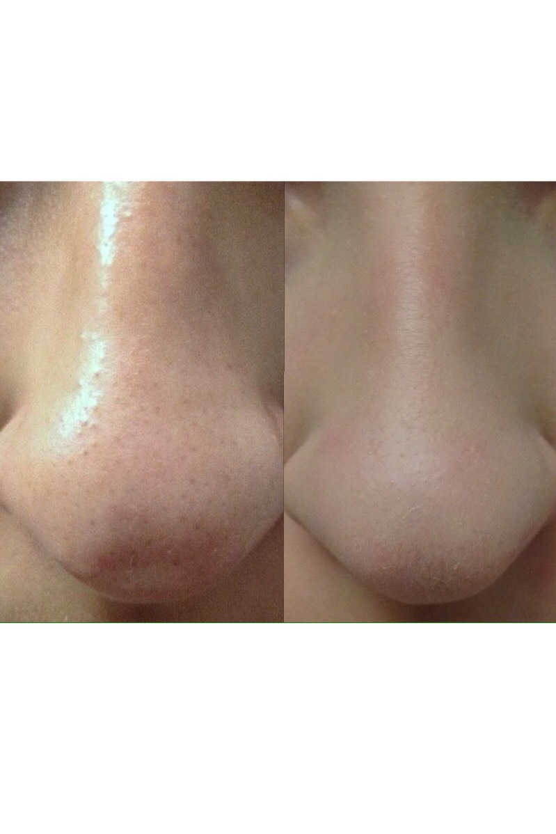How to Cleanly Remove Blackheads Painlessly!